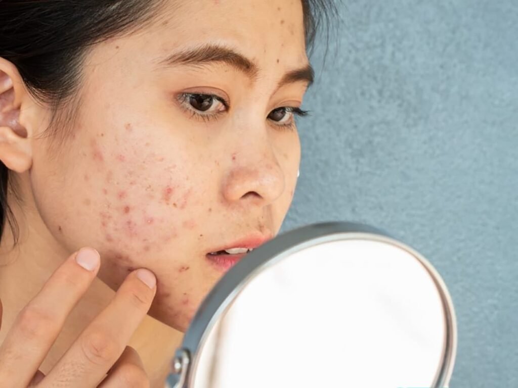 Types Of Acne: Private-Label Guide For Actives, Concentrations, Ph, Claims